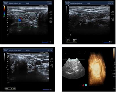 Challenges in autoimmune polyendocrine syndrome type 2 with the full triad induced by anti-programmed cell death 1: a case report and review of the literature